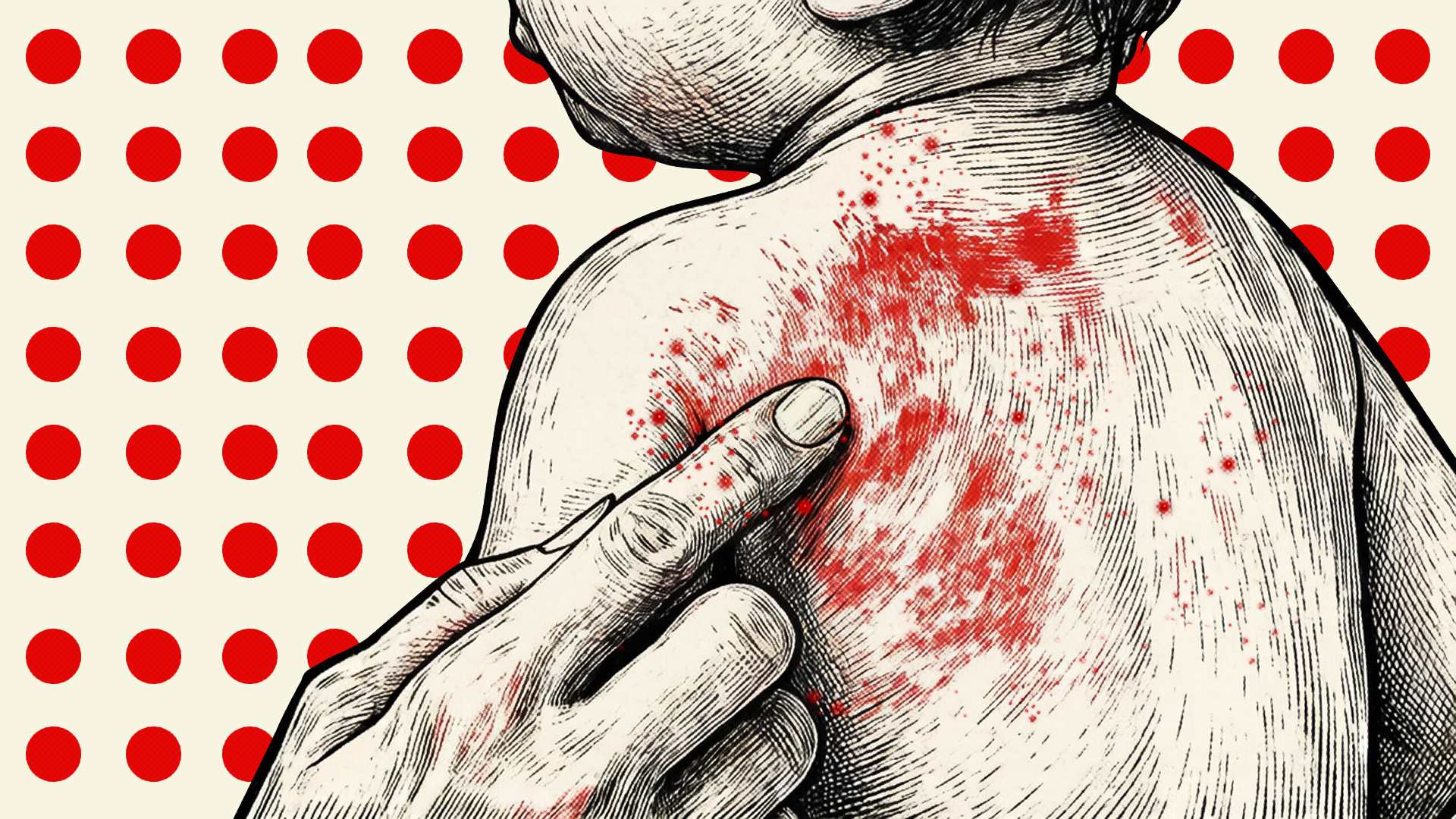 Measles outbreak: 7 more die as death toll crosses 600