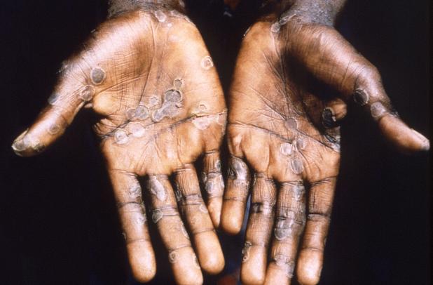 Good news: Smallpox vaccine 85% effective in preventing monkeypox
