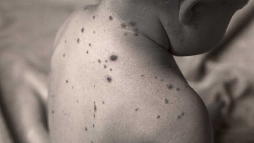 Measles.jpg