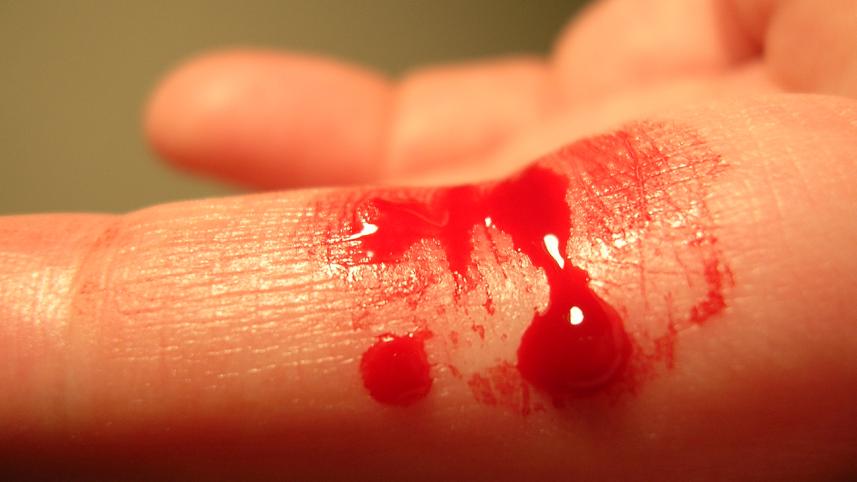 Bleeding_finger.jpg