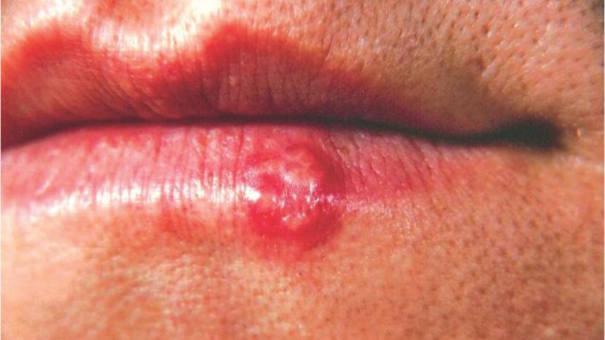 blisters