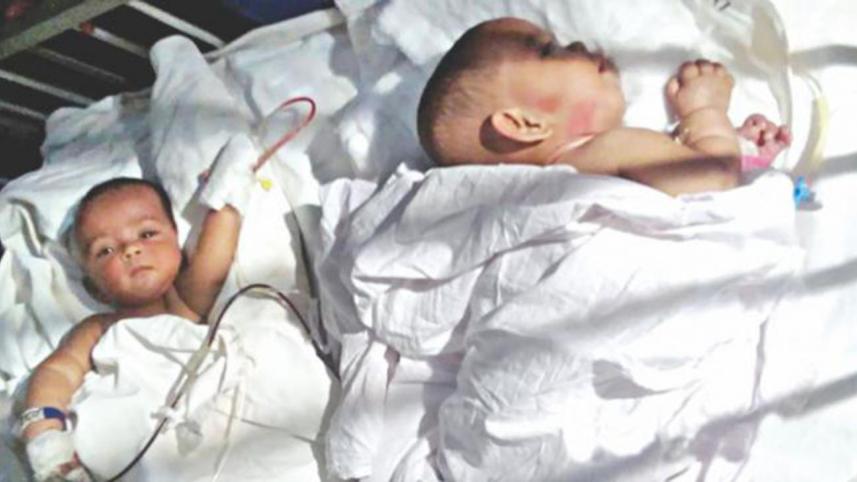conjoined_separated_0.jpg