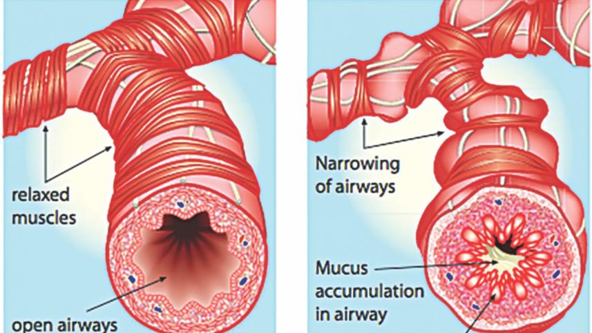COPD cases