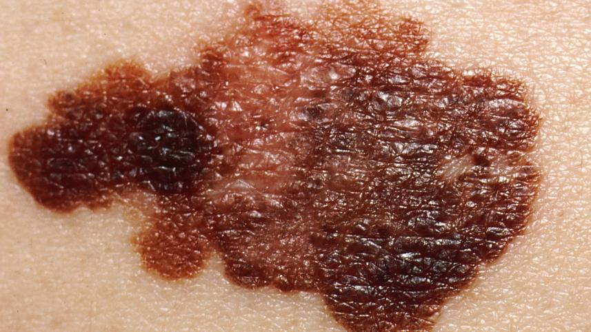 Ipilimumab, nivolumab, skin cancer, melanoma, England 
