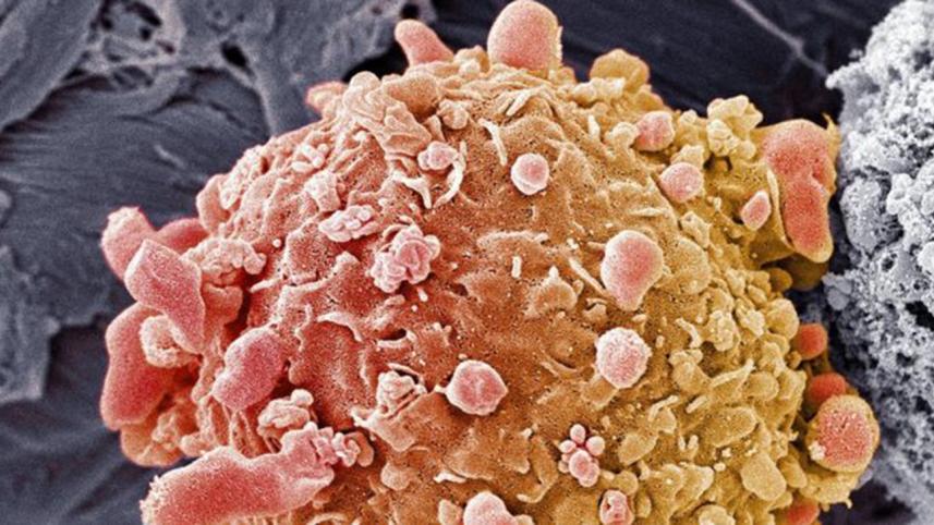 Melanoma 2.jpg