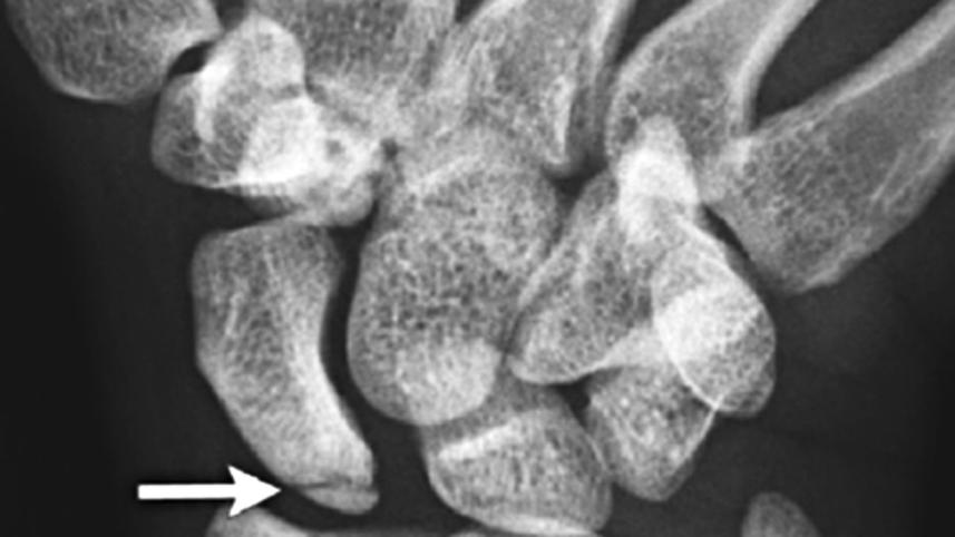 wrist fracture.jpg