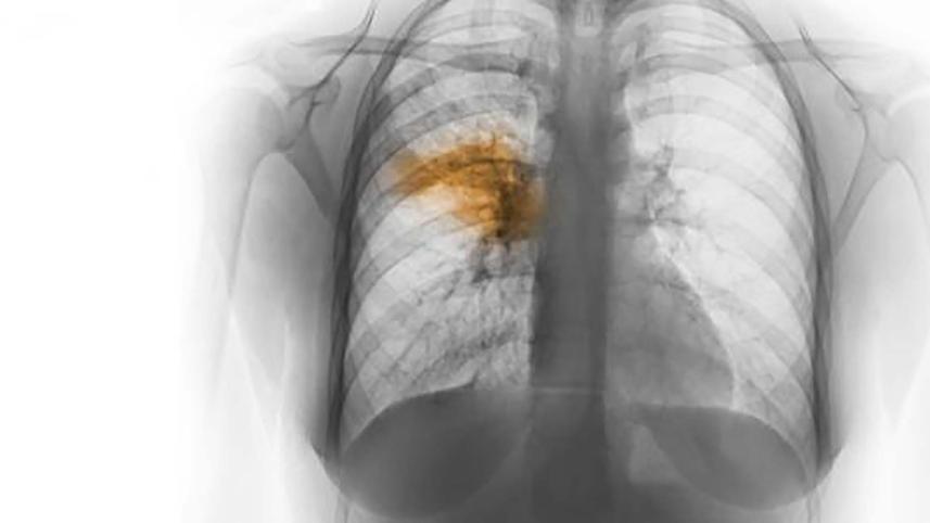 pneumonia.jpg