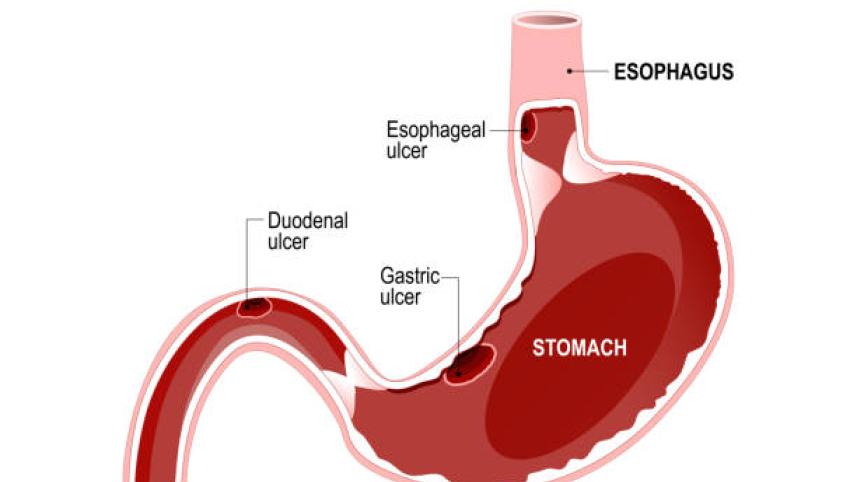 Following these diet recommendations will help ease the discomfort of ulcer during Ramadan. 