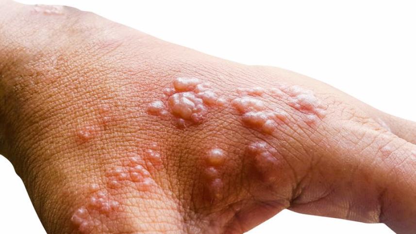 monkeypox_1.jpg