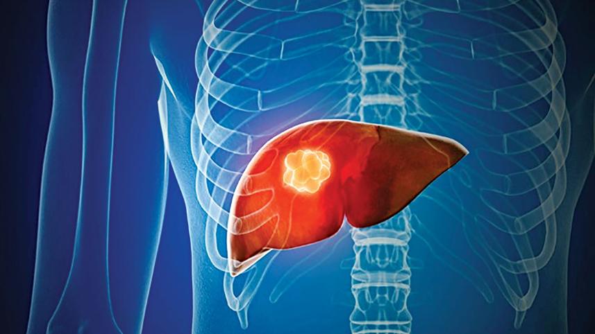 nafld.jpg