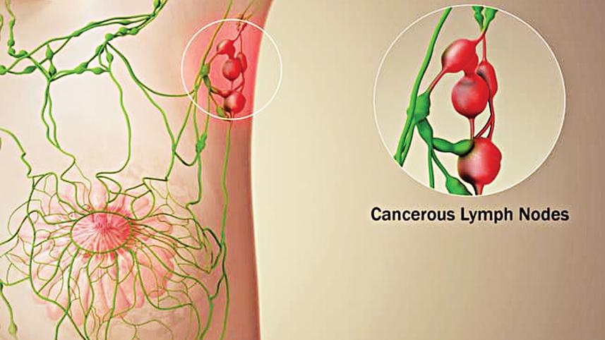 breast-cancer-treatment.jpg