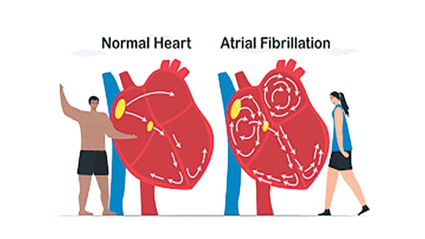 fibrillation.jpg