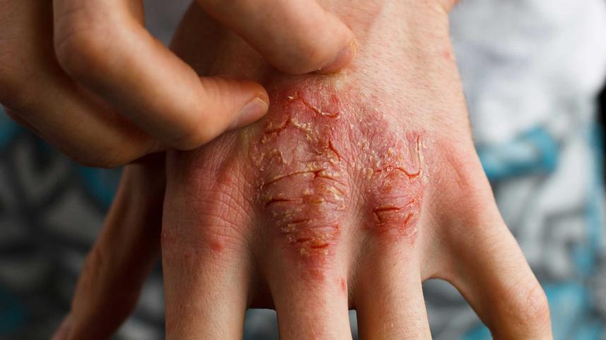 managing-eczema.jpg