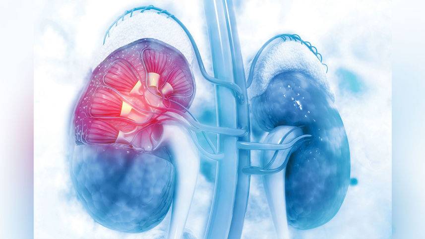 renal-denervation.jpg