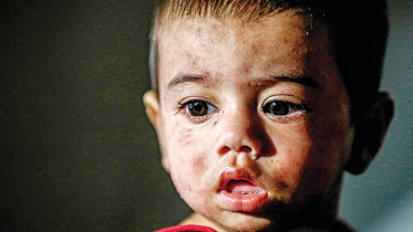 measles cases rising in Bangladesh