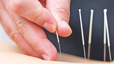 Acupuncture.jpg