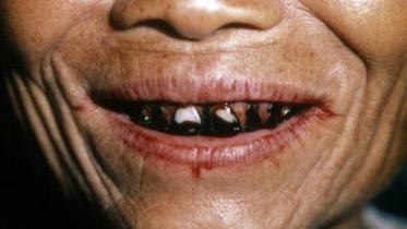 betel nut chewers