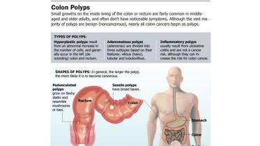 colon-polyps-lead-colon-cancers-101117.jpg