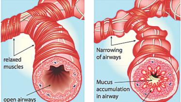 COPD cases