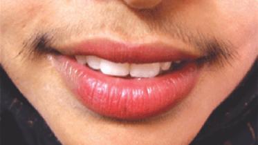 Hirsutism.jpg