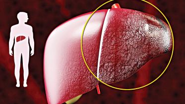 liver-cirrhosis.jpg