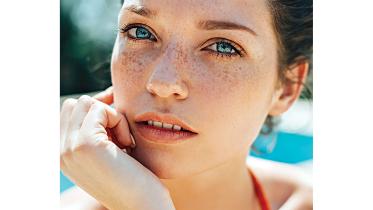 melasma-2.jpg