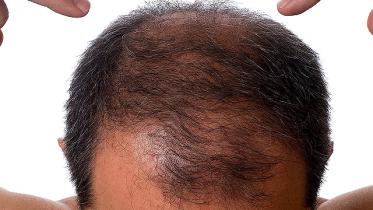 A cure for Alopecia or baldness has been discovered by scientists at Concert Pharmaceuticals, a U.S. based pharmaceutical company.