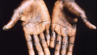 monkeypox-web.jpg