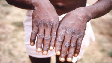 monkeypox.jpg