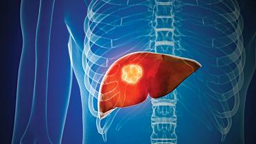 nafld.jpg