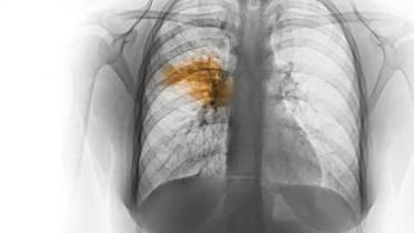 pneumonia.jpg