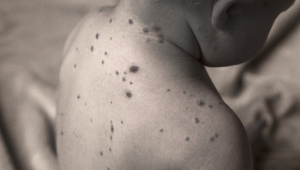Measles.jpg