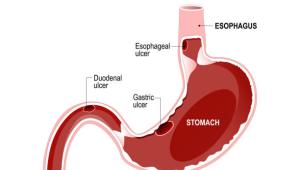 Following these diet recommendations will help ease the discomfort of ulcer during Ramadan. 